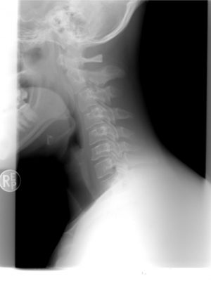 cervical spine, xray, patient